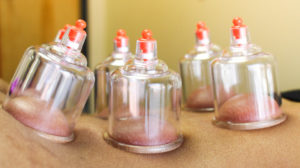 Cupping Therapy – One on One Physical Therapy Cupping Therapy - One on One Physical Therapy