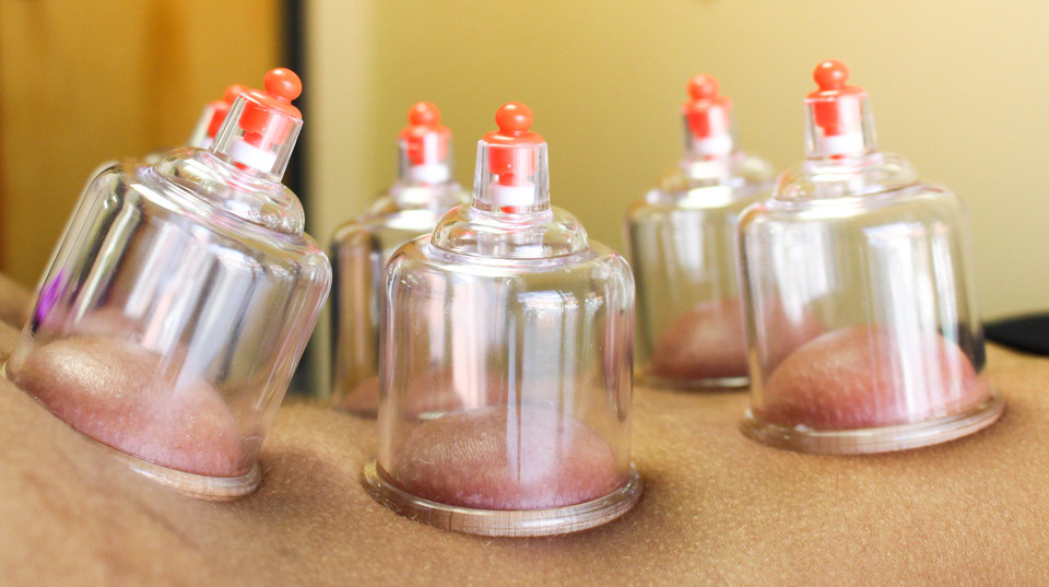 Cupping Therapy - One on One Physical Therapy