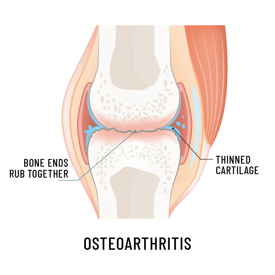 Osteoarthritis