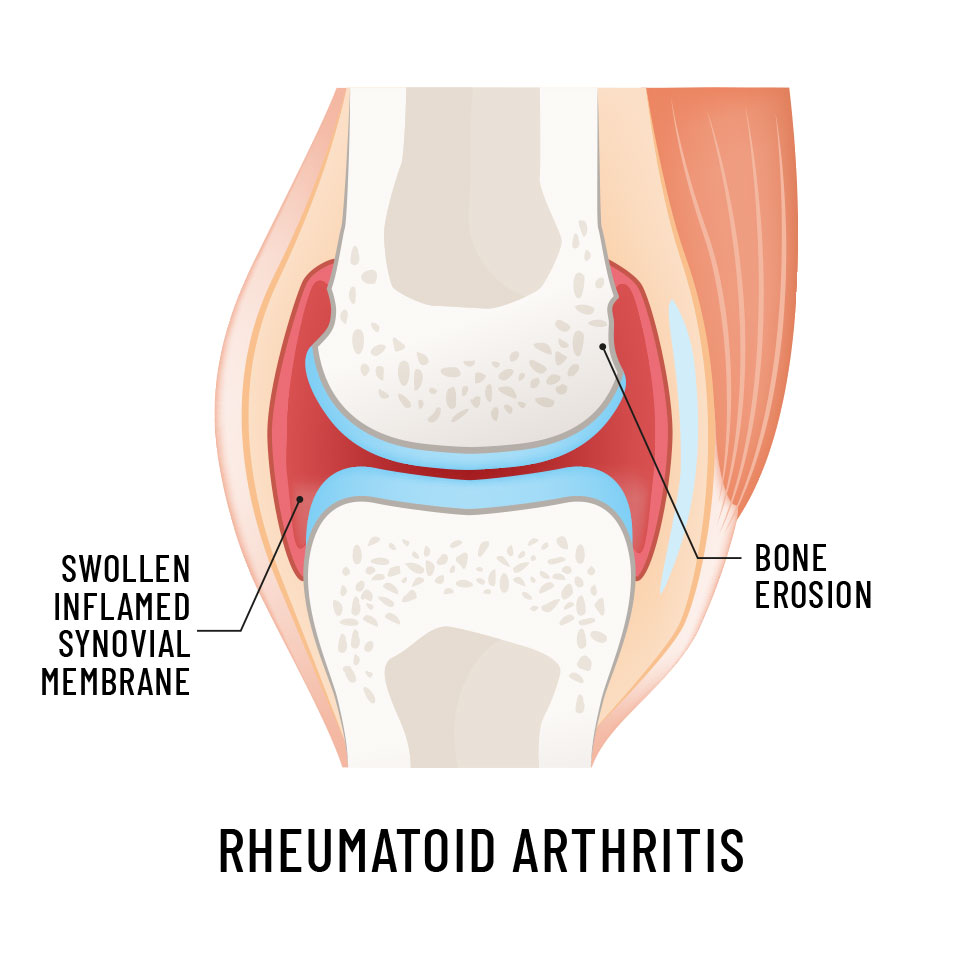 Rheumatoid Arthritis