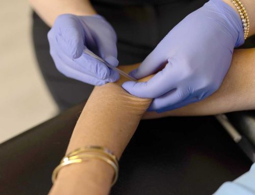 Dry Needling vs. Acupuncture: What Patients Need to Know About Trigger Points, Referred Pain, and Treatment Techniques