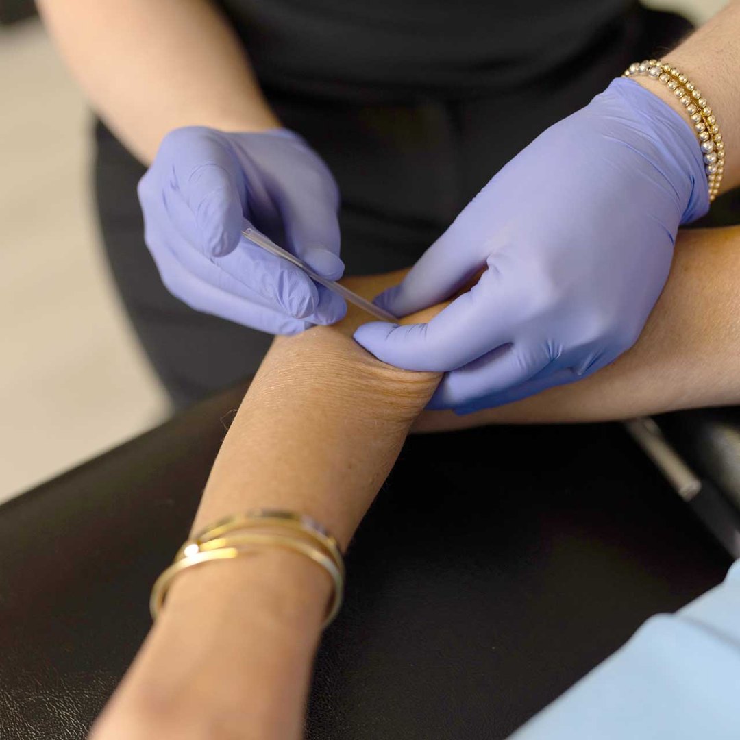 Physical therapist inserting a dry needling needle into a patient's forearm at One on One Physical Therapy in Atlanta